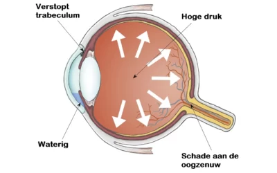 Wat is glaucoom?