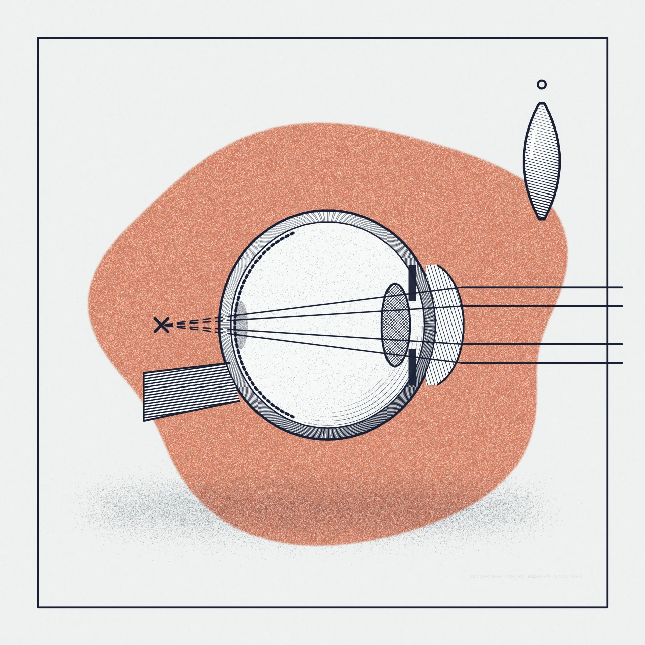 Gravure van een verziend oog in doorsnede: het brandpunt ligt achter het netvlies, met een plusglas als oplossing